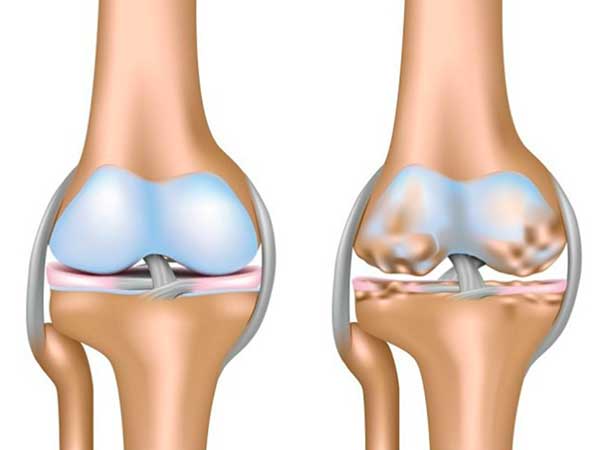 Bol u kolenu: Kako nastaje i koja terapija je najefikasnija